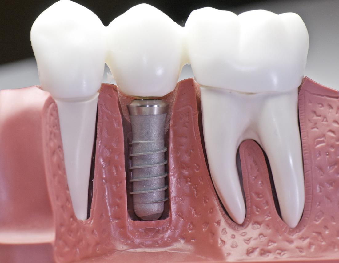 When to Consider Dental Implants