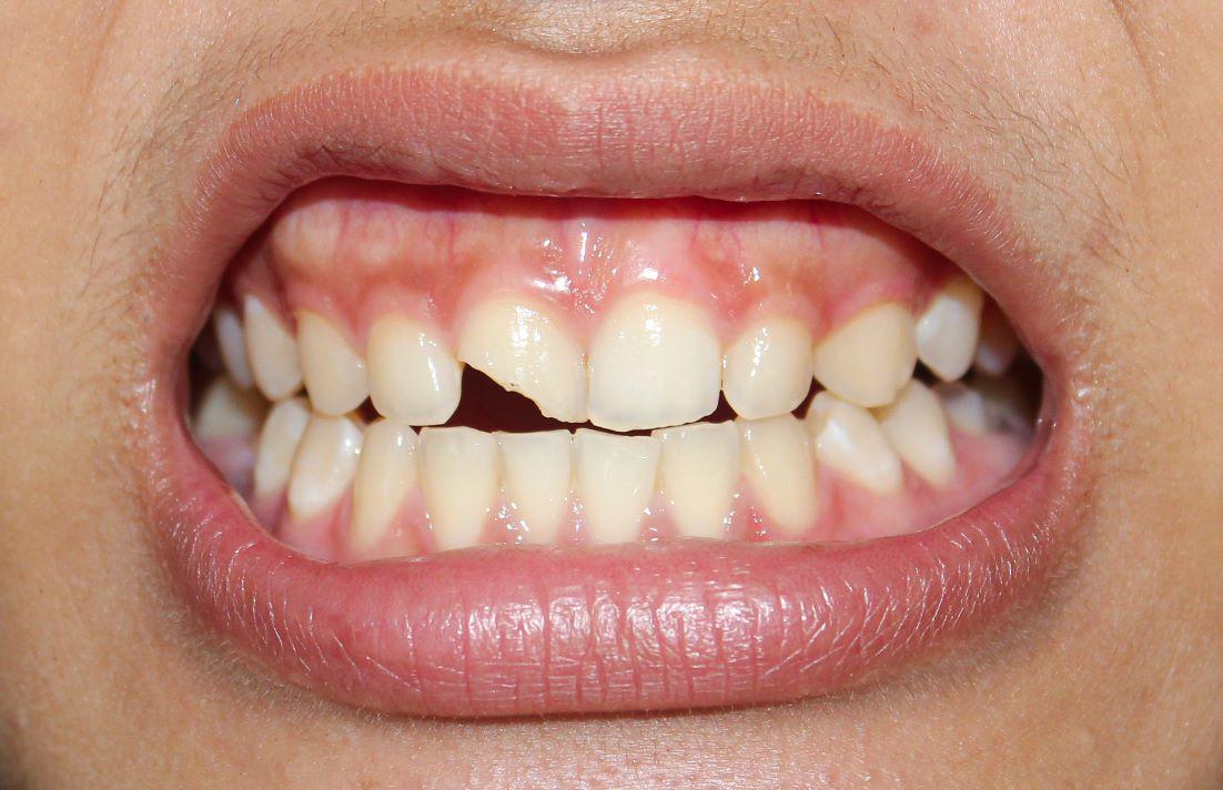 Options for Repairing a Chipped Tooth