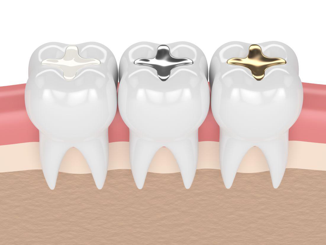 Types of Dental Fillings