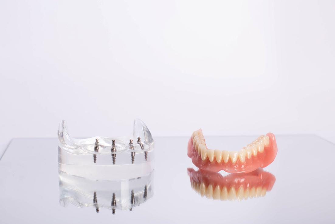 Implants vs Dentures