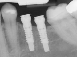 Implant Dentistry Sarasota FL
